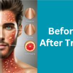 Before and After Tretinoin