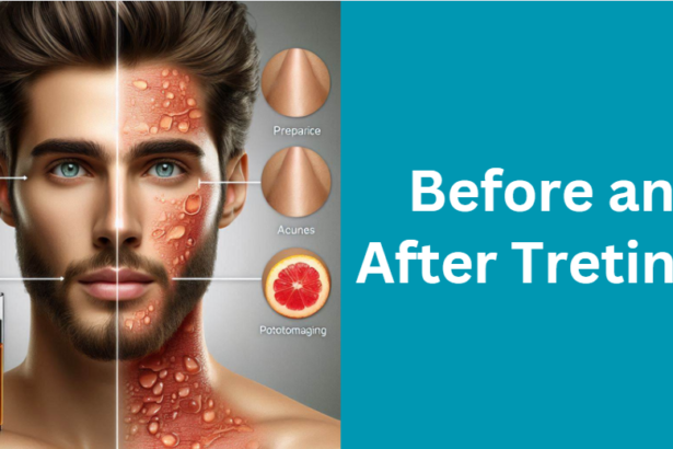 Before and After Tretinoin