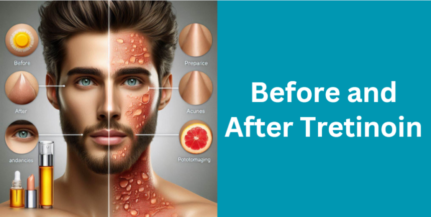 Before and After Tretinoin