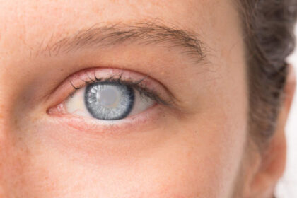 8 Tips for Preventing Cataracts